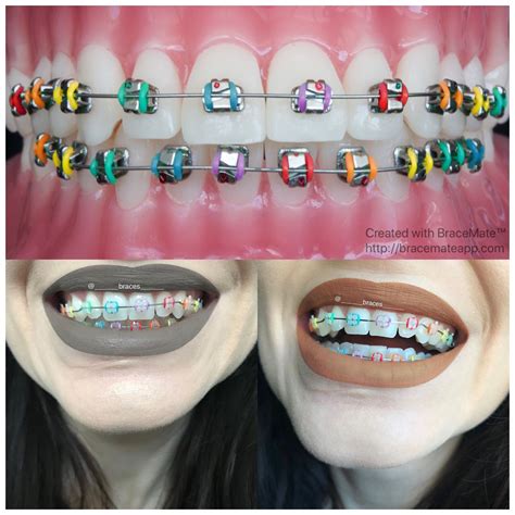 ligas metalicas brackets|ligas de colores brackets.